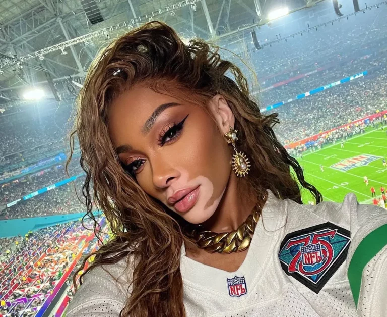 Winnie Harlow Biography, Age, Height, Figure, Net Worth